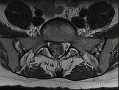 Disc herniation - cauda equina compression