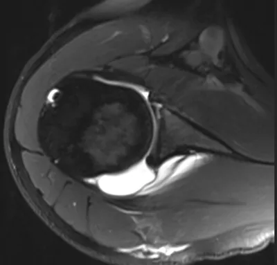 GLAD (glenolabral articular disruption) lesion