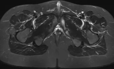Van Neck Odelberg Disease - Ischiopubic Synchondritis