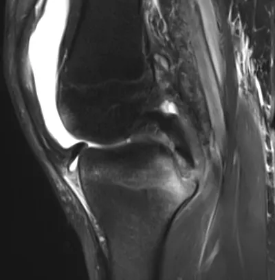PCL avulsion injury