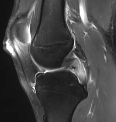 Posterior Cruciate Ligament Tear