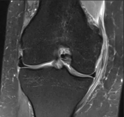 Grade 2 MCL injury