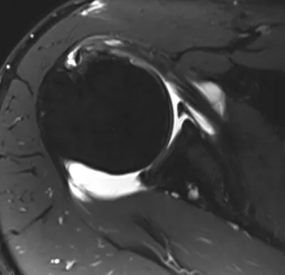 Anterior Labroligamentous Periosteal Sleeve Avulsion (ALPSA) lesion