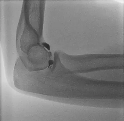 Elbow joint injection