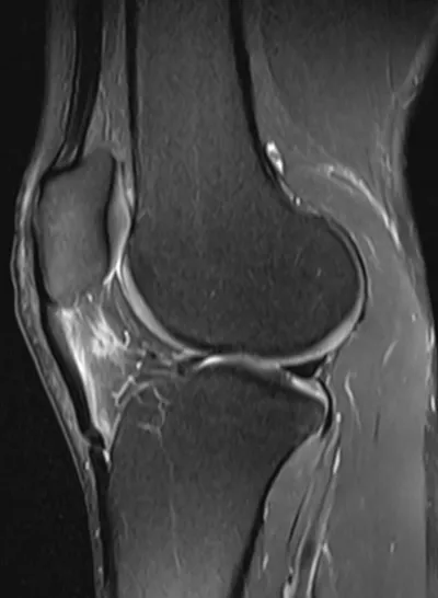Patellar tendinitis - Jumper's Knee