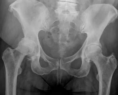 Avascular Necrosis right femoral head