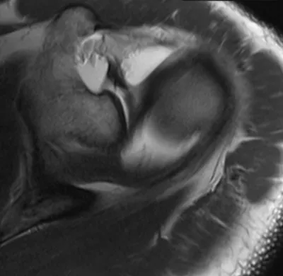 SLAP tear (Superior Labrum Anterior and Posterior)