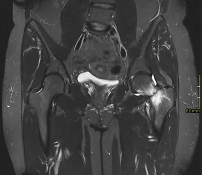 Femoral neck stress fracture (complete)