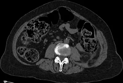Stercoral perforation