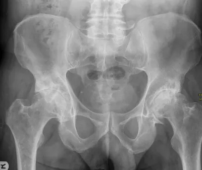 Osteoarthritis of hips (Advanced stage)