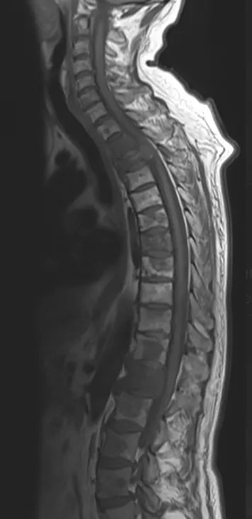 Metastatic Spinal Cord Compression