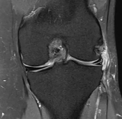 Medial meniscus tear + parameniscal cyst