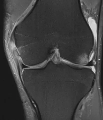 Medial Collateral Ligament Injury (Grade 2)