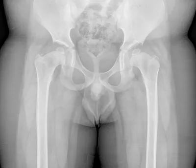 Multiple epiphyseal dysplasia