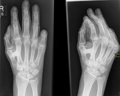 Ripon Hand - fused metacarpal dysplasia