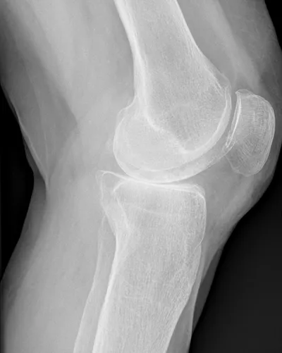 Patella Baja