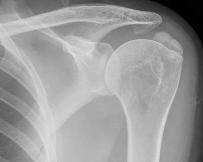 Calcific tendinopathy of supraspinatus