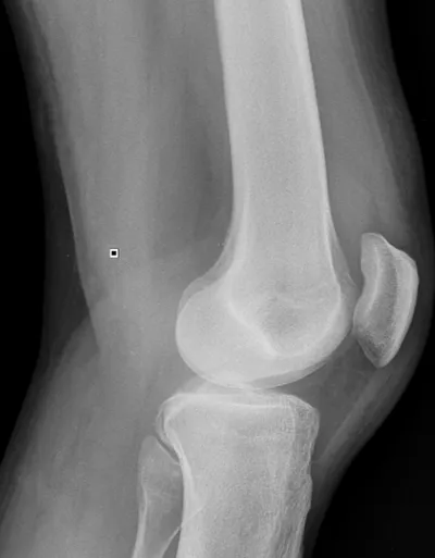 Suprapatellar effusion