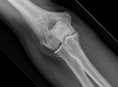 Common extensor enthesopathy (tennis elbow)