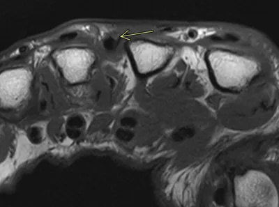 Sagittal band rupture