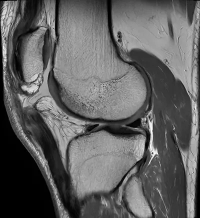 Patellar tendon tear