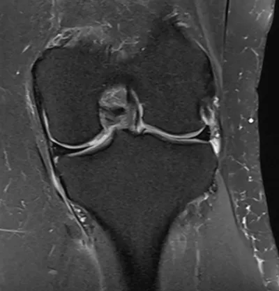 Cartilage defect medial femoral condyle