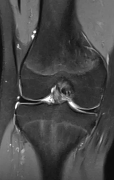 Bilateral complte discoid mensical cartilages