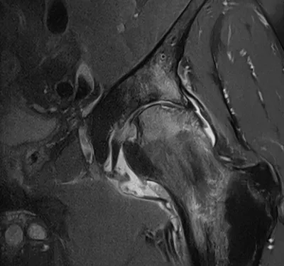 Avascular Necrosis (AVN) of femoral head