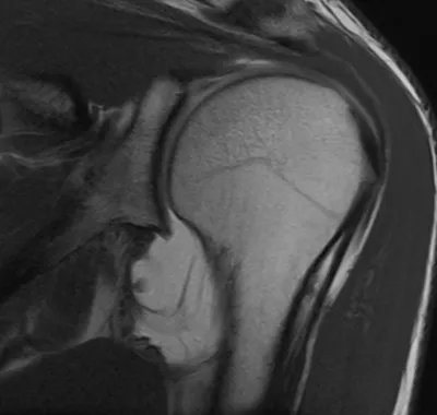 Inferior glenohumeral ligament injury post dislocation