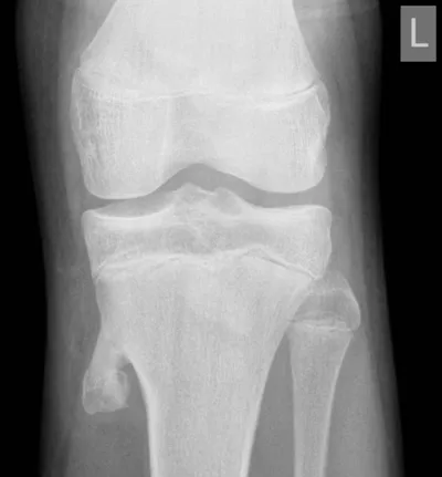 Osteochondroma