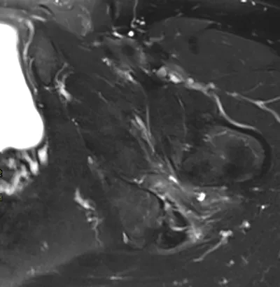 Ischiofemoral impingement