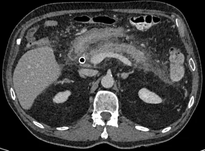Pancreatitis post ERCP