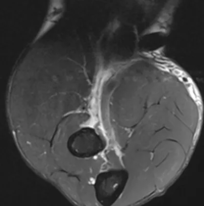 Distal biceps tendon tear and retraction