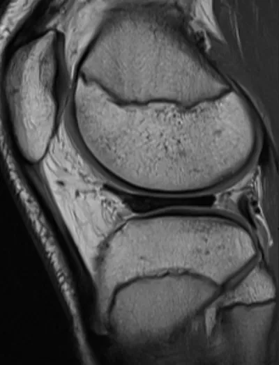 Meniscocapsular separation