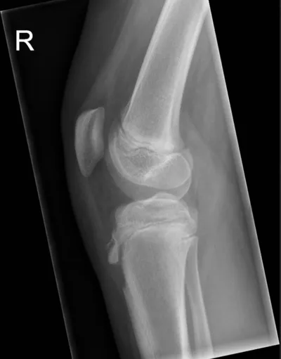 Osgood Schlatter Apophysitis