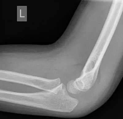 Sail sign of elbow effusions