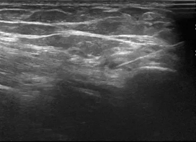 Injection of lateral femoral cutaneous nerve for meralgia paraesthetica