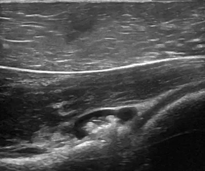 Posterior glenoid labral tear