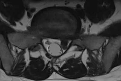 Disc protrusion - Left L5-S1