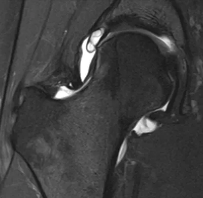 Torn acetabular labrum with intralabral cyst
