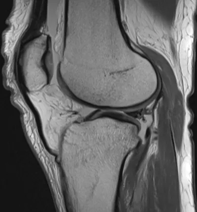 Posterior meniscocapsular ligament injury