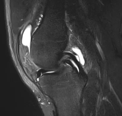 Double PCL sign - bucket handle tear of meniscus