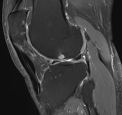Double crossed patellar tendon