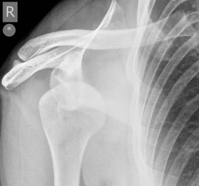 Anterior glenohumeral dislocation