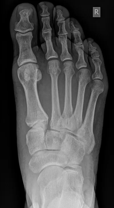 Lis Franc Injury
