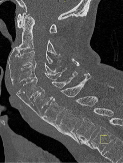 Chalk stick fracture in fused spine