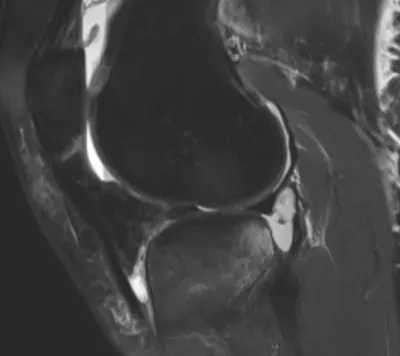 Meniscocapsular ligament tear