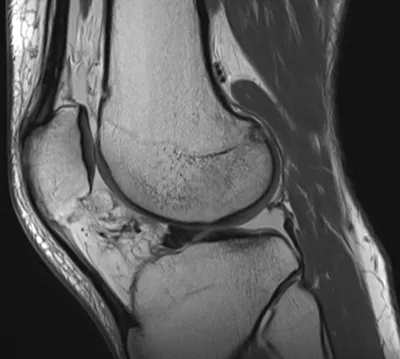 Bucket handle tear of lateral meniscus