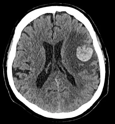 Hyperdense melanoma brain metastasis