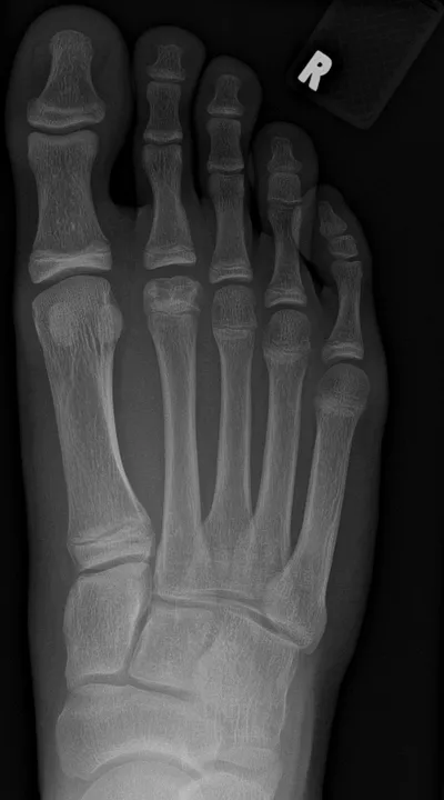 Freiburg Osteonecrosis - 2nd metatarsal head